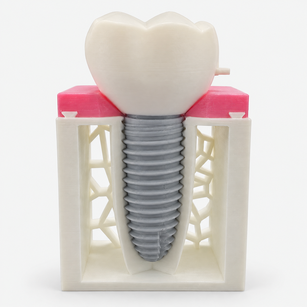Dimensions Implant Teaching Model — الموديل المطبوع مع التاج، من تصوير المنتج الحقيقي