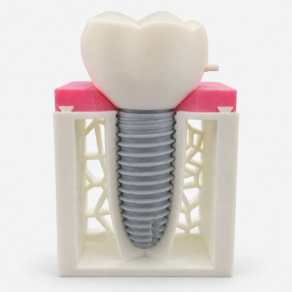 Dimensions Implant Teaching Model — الموديل المطبوع مع التاج، من تصوير المنتج الحقيقي